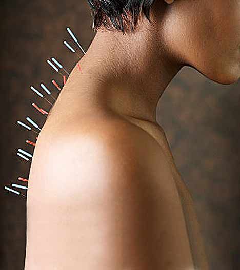 Urban Acupuncture, Acupuncture Benefits, Acupuncture Needles, Western Medicine, Alternative Healing, Traditional Chinese Medicine, Chinese Medicine, Holistic Healing, Acupressure