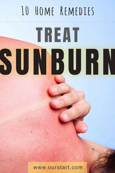 Sunburn Relief Essential Oils, Sunburn Home Remedies, Diy Sunburn Relief, Sunburn Remedy, Remedies For Sunburn, Home Remedies For Sunburn, Severe Sunburn, Get Rid Of Sunburn, Homemade Cold Remedies