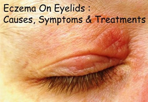 Eczema On Eyelids : Causes, Symptoms & Treatments | Disfreeskin Dry Eyelids Remedy, Wrinkly Eyelids, Dry Eyes Remedy Natural Treatments, Swollen Eyelids Remedy, Dry Eye Remedies, Itchy Eyelids, Dry Eyelids, Dry Eye, Itchy Eyes