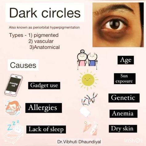 𝗗𝗿.𝗩𝗶𝗯𝗵𝘂𝘁𝗶-𝗔𝗲𝘀𝘁𝗵𝗲𝘁𝗶𝗰 𝗠𝗲𝗱𝗶𝗰𝗶𝗻𝗲 on Instagram: “DARK CIRCLES People often think dark circles are due to tiredness and a lack of sleep. Although this can be one cause, there are other…” Periorbital Dark Circles, Aesthetic Medicine, Dark Circle, Lack Of Sleep, Dark Circles, Dry Skin, Allergies, Circles, Body Care