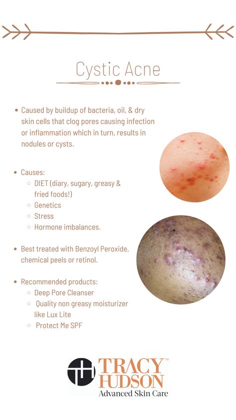 Hormonal Cystic Acne, Cystic Acne Skin Care Routine, Acne Reasons, Cystic Acne Remedies, Acne Diet, Skin Diet, Acne Skincare Routine, Face Skin Care Routine, Skin Facts