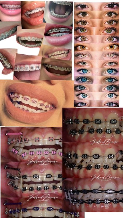 Braces Colors Christmas, Braces On Crooked Teeth, Braces With Rubber Bands, Braces Colors Combinations, Red Braces, Braces Colors Ideas, Orthodontics Teeth, Braces Food, Cute Teeth