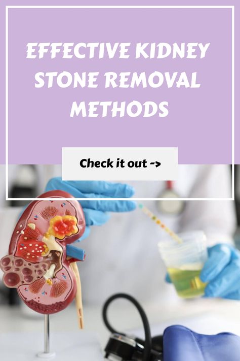 Medical professional demonstrating kidney stone removal using a model. Kidney Stone Remedies, Kidney Stone Relief, Educating Yourself, Kidney Stone, Health Podcast, Unhealthy Diet, Acupuncture Points, Holistic Remedies, Homemade Remedies