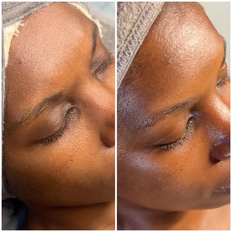 Consistency brings results! 🌟 Check out these incredible results after just two treatments at Skynvy Houston. Notice the visible improvements in skin texture and radiance between the first and second sessions. Consistent professional care combined with diligent home skincare routines truly makes all the difference. Swipe to see the transformation and imagine what could be achieved with continued care! Are you ready to begin your own skin transformation journey? Book your appointment today an... Skin Transformation, Chemical Peels, Chemical Peel, Skincare Routines, Book Your Appointment, Best Skin, Skin Texture, Care Routine, Skincare Routine