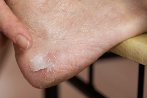 Home Remedies for Extremely Dry Feet Dry Feet Remedies, Crusty Skin, Healthy Heart Tips, Dry Skin Body, Skin Hand, Dry Skin Patches, Cracked Skin, Skin Remedies, Beauty Skin Care Routine