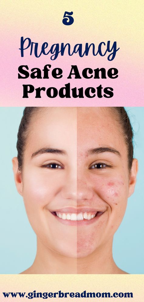 Pregnancy acne is a bummer and not all acne products are pregnancy safe. These 5 acne products are dermatologist approved and considered safe to use during pregnancy. #pregnancysafeacneproducts #pregnancyhack #pregnancyacne Pregnancy Safe Skin Care, Pregnancy Acne, Acne Body Wash, Acne Medicine, Pregnancy Hacks, Acne Products, Pregnancy Skincare, Bad Acne, Acne Mask