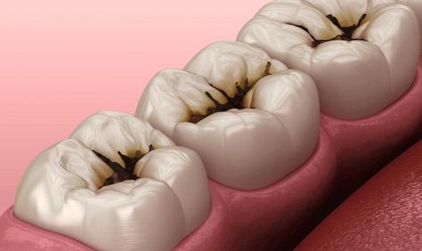 A tooth cavity, or dental caries or decay, is a localized area of damage to the tooth’s hard tissues, primarily caused by bacterial activity. When sugars and starches in food interact with bacteria in the mouth, they produce acid that erodes the tooth enamel. Over time, this process leads to the formation of cavities, compromising the tooth’s structure. Tooth Caries, Dental Pictures, Dental Advertising, Dental Images, Dental Decay, Tooth Cavity, Best Dental Implants, Dental Videos, Dental Health Care