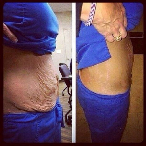 Stretch mark cream before and after pics. The results are amazing ‼️ask me how to get these and many more products at discount price ! It works ! Loose Skin On Stomach, Tighten Stomach Skin, Saggy Belly Skin, Saggy Belly, Tighten Stomach, Skin Firming Lotion, Bumps On Skin, Saggy Neck, Skin Tightening Stomach