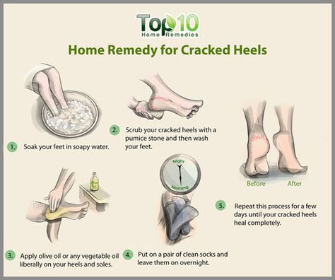 Cracked Heel Remedies, Heal Cracked Heels, Dry Cracked Heels, Dry Heels, Top 10 Home Remedies, Sugar Scrub Diy, Cracked Heels, Coconut Oil For Skin, Headache Relief