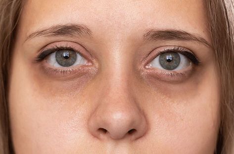 Dark Circles Under the Eyes: Causes and Treatments Remove Dark Circles, Dark Under Eye, Dark Circles Under Eyes, Undereye Circles, Eye Bags, Reduce Wrinkles, Eye Area, Eye Care, Dark Circles