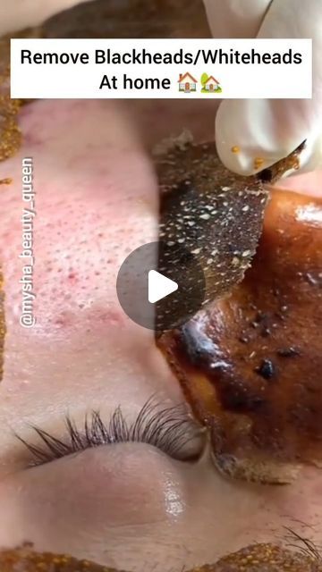 Mysha beauty queen (influencer) on Instagram: "Nose Blackheads/Whiteheads removal in 1 one day with this easy DIY mask| if you have lots of blackheads and whiteheads issue on your nose and cheek area so try this. .  . Repeat every week.. . . Follow for more . @mysha_beauty_queen  #skincare #skincareroutine #blackheads #whiteheads #acne #reels#viralreels #viralsong #viralbeautytips #viralreelsvideo #viralpost #trending #trend #trekking #homeremedies #homeremedy #instagramreels #insta #beautifulgirls #shorts #viralinstagram #glowathome #glowingskin#beautybloggers #beautytips #reelsinstagram #openpores #blackheads #whiteheads #opera #skincaretips" Whiteheads Removal, Nose Blackheads, Blackheads And Whiteheads, Beginners Eye Makeup, Game Day Hair, Skin Care Order, Hoco Makeup, Skin Care Items, Skincare Video