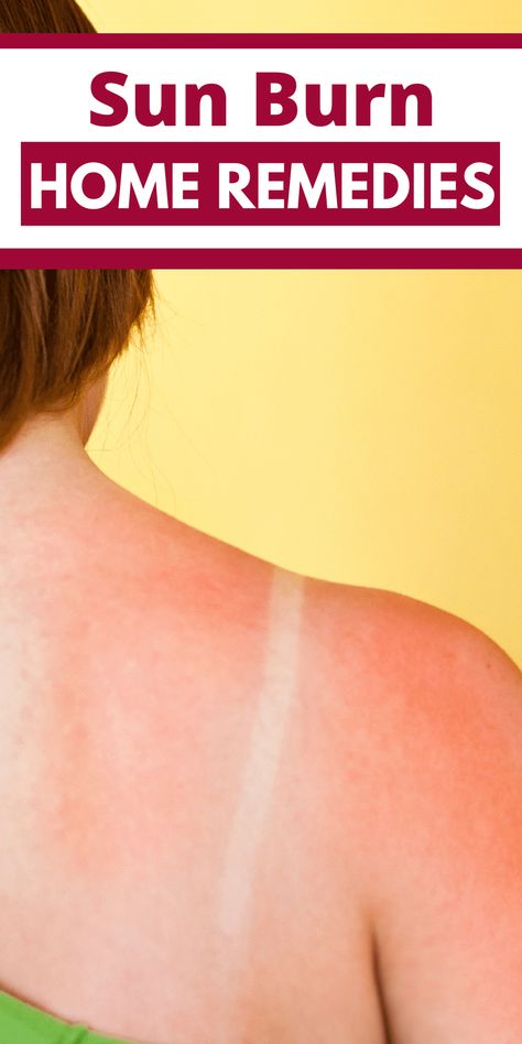 7 Home Remedies for Sunburn | Midwest Modern Momma Remedies For Sunburn, Home Remedies For Sunburn, Severe Sunburn, Sunburn Remedies, Makeup Shades, The Sting, Aloe Plant, Male Fitness Models, Cotton Ball