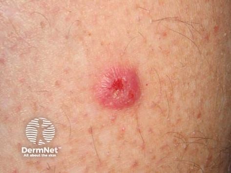 Squamous cell carcinoma of limbs images Squamous Carcinoma, Basil Cell Carcinoma, Skin Symptoms, Skin Rashes, Heat Rash, Squamous Cell, Athletes Foot, Cold Sore, Skin Conditions