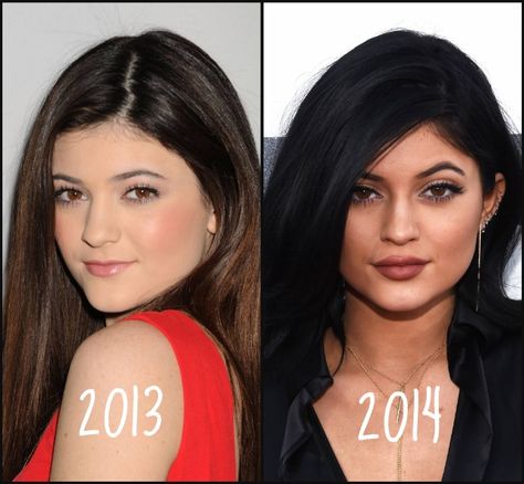 Kylie Jenner #KylieJenner #Beautiful #Celebrity #Stunning #FacePic #BeforeAndAfter Wide Lips, Kylie Jenner Plastic Surgery, Botox Brow Lift, Jenner Girls, Kylie Jenner Pictures, Kylie Jenner Lips, Jenner Makeup, Diy Beauty Treatments, Facial Fillers