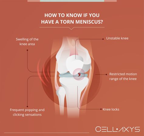 how to heal a torn meniscus naturally Effective Study Tips, Homemade Facials, Knee Exercises, Knee Pain Relief, Natural Healing Remedies, Simple Health, Go Crazy, Knee Injury, Body Skin Care Routine