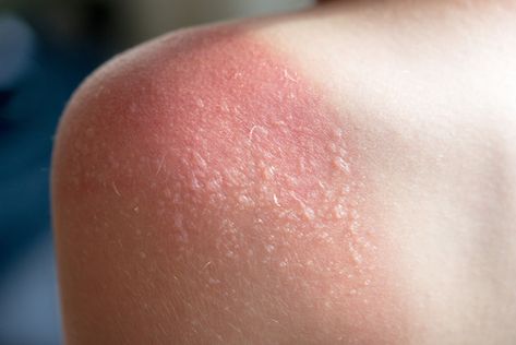 Sun Blisters, Sun Poisoning, Sunburn Blisters, Blister Remedies, How To Heal Blisters, Severe Sunburn, How To Treat Sunburn, Sunburn Peeling, Heal Sunburn