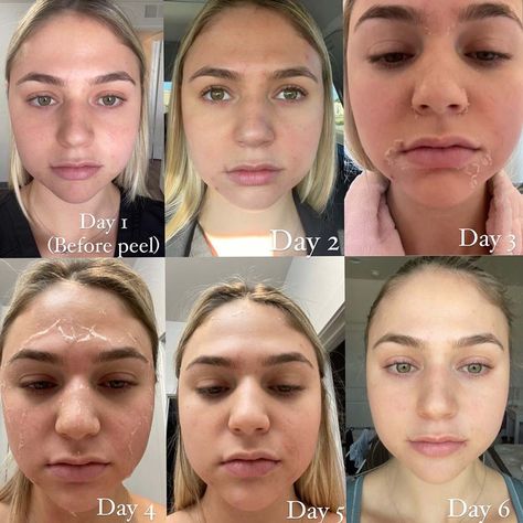 Day by Day Chemical Peel Recovery - The Ultimate Guide Chemical Peel Before And After, Best Chemical Peel, Chemical Peeling, Flaking Skin, Chemical Peels, Facial Peel, Chemical Peel, Day By Day, Skin Healing