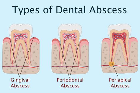 Tooth Abcess Remedy, Absessed Tooth, Abcessed Tooth, Dental Abscess, Abscess Tooth, Teeth Remedies, Dental Social Media, Tooth Infection, Tooth Removal