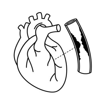 heart drawing,heart sketch,fat,showing,rupture,problem,biology,heart,closed,body,science,surgery,sickness,health,illustration,blood,graphic,outline,circulation,medicine,human,with,comparison,hospital,coronary,artery,attack,structure,symbol,narrowed,capillaries,arterial,life,disease,part,patient,damaged,fatty,sign,embolism,concept,awareness,illness,plaque,system,cholesterol,symptoms,coagulate,pressure,organs,info,care,cardiologist,medical,vessel,blocked,specialist Biology Heart, Health Illustration, Drawing Heart, Body Science, Cholesterol Symptoms, Coronary Artery, Coronary Arteries, Heart Sketch, Psd Background