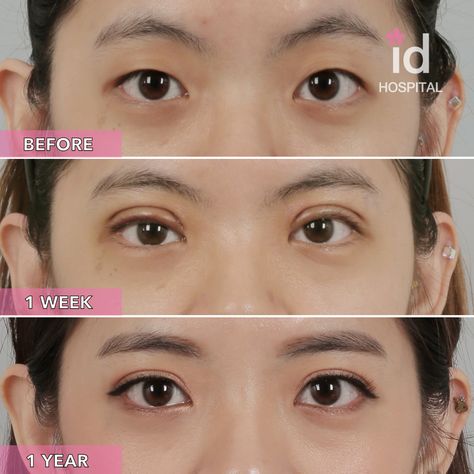 #idhospitalkorea #idhospital #idbeforeandafter #plasticsurgery #koreanplasticsurgery #plasticsurgerykorea #plasticsurgerybeforeandafter #cosmeticsurgery #upperblepharoplasty #doubleeyelidsurgery #doubleeyelid #monolid #ptosiscorrection #beforeandafterdoubleeyelid #eyesurgery Plastic Surgery Korea, Korean Plastic Surgery, Monolid Makeup, Bold Makeup Looks, Double Eyelid, Eye Surgery, Bold Makeup, Cosmetic Surgery, Free Consultation