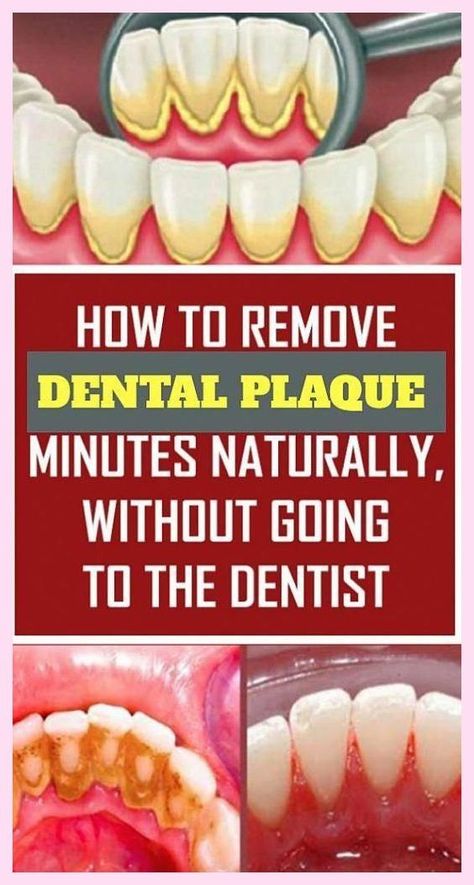 Remove Plaque From Your Teeth Just In 2 Minutes! Teeth Surfaces, Organic Toothpaste, Dental Plaque, Firmer Skin, Plaque Removal, Dental Procedures, Health And Fitness Articles, Vicks Vaporub, Dental Problems