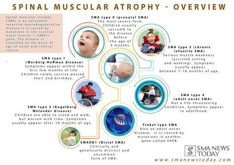 While most types of SMA typically affect children from birth, there are some types of the condition which do not present symptoms until adulthood. Elhers Danlos Syndrome, Spinal Muscular Atrophy, Muscular Development, Motor Neuron, Muscle Weakness, Developmental Milestones, Rare Disease, Spinal Cord, Muscle Tone