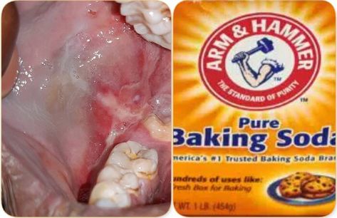 Baking soda for oral lichen planus [Use & Benefits] Brushing With Baking Soda, Folate Rich Foods, Lichen Planus, Baking Soda Benefits, Spearmint Essential Oil, Pure Aloe Vera, Acidic Foods, Fermented Drink, Baking Soda Uses