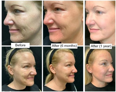 Morpheus 8 Before And After Face, Morpheus8 Before And After, Morpheus 8 Before And After, Medical Machine, Morpheus 8, Acne Scarring, Thread Lift, Face Mapping, Uneven Skin Texture