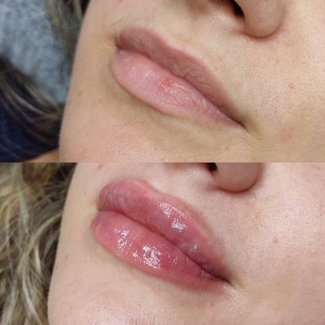 Hyaluron Lip Filler, Bb Lips, Hyaluronic Acid Lips, Lips Inspiration, Aesthetic Dermatology, Lipstick For Dark Skin, Facial Fillers, Cosmetic Injectables, Facial Aesthetics