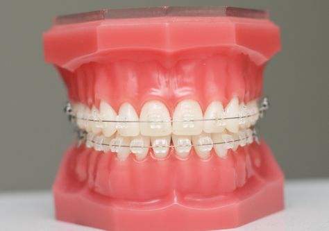 Ceramic Braces Aesthetic, Clear Braces Ceramics, Teeth Braces Aesthetic, Transparent Braces, Braces Colors Ideas Cute, Braces On Teeth, Braces For Teeth, Braces Aesthetic, Braces Colors Ideas