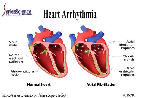 Heart arrhythmia (also known as arrhythmia, dysrhythmia or irregular heartbeat) is a group of conditions in which the #Heartbeat is irregular, too fast or too slow.  #seriesscience #JSCR #Cardiology #heartattack #stroke chest #pain #ECG For more info, please visit: https://seriesscience.com/journal-cardio/ Circulatory System Diseases, Sinus Congestion Relief, Congestion Relief, Normal Heart, Sinus Congestion, Atrial Fibrillation, Coronary Arteries, Heart Surgery, Shortness Of Breath