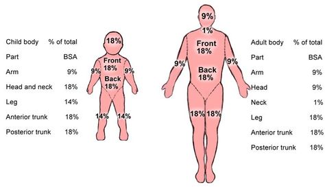 Rule of 9 for burn victims | PTA | Pinterest | Nine D'urso and Html Rules Of 9 Burns, Rules Of Nine Burn, Rule Of 9 Burns Nursing, Rule Of Nines For Burns, Rule Of 9 Burns, Burns Nursing, Rule Of Nines, Emt Basic, Burn Victims