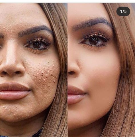 Acne Free Skin, Makeup News, Celebrity Plastic Surgery, Cystic Acne, Makeup Mirrors, Instagram Tags, Makeup Geek, Nyx Cosmetics, Insta Makeup