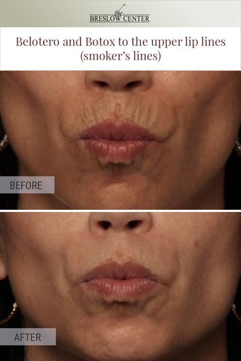 Smoker Lines Before And After, Upper Lip Filler Before And After, Lip Filler For Smoker Lines, Lip Line Filler, Upper Lip Wrinkles, Paramus Nj, Derma Fillers, Beauty Job, Botox Brow Lift