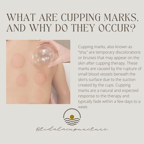 Curious about traditional fire cupping? 🔥Book a session with us today! Our skilled practitioners will walk you through every step of the process to make sure you’re comfortable and leave the office feeling better than ever 😌☁️ #FireCupping #HolisticHealth Fire Cupping, Massage Marketing, Sports Therapy, Skin Aesthetics, Wellness Massage, Cupping Therapy, Feeling Better, Web Project, Blood Vessels