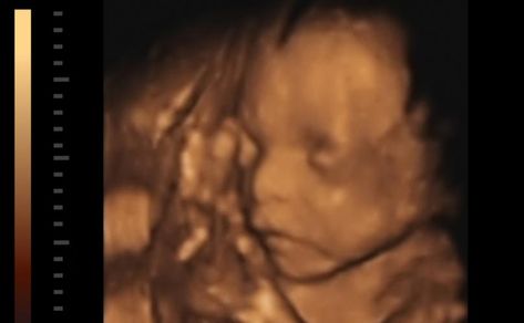 3d Ultrasound Pictures, Body Changes During Pregnancy, 3d Ultrasound, Human Embryo, High Court Judge, 20 Weeks Pregnant, Ultrasound Pictures, Pregnancy Guide, 20 Weeks