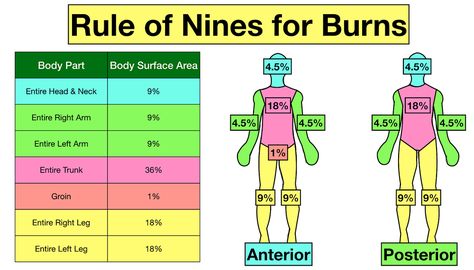 Rules Of 9 Burns, Rule Of 9 Burns Nursing, Rule Of Nines For Burns, Rule Of 9 Burns, Emt Notes, Burns Nursing, Rule Of Nines, Floyd Leg, Medical Learning