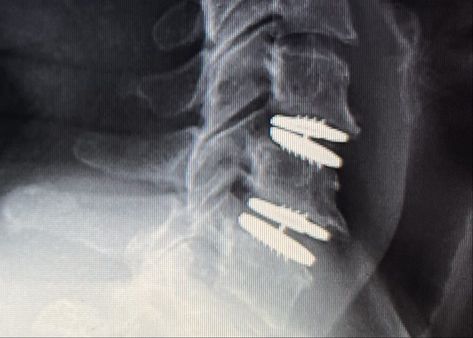 Cervical Artificial Disc Replacement - CDA Spine Cervical Disc, Intervertebral Disc, Hyperbaric Oxygen Therapy, Spinal Fusion, Pemf Therapy, Bioidentical Hormones, Oxygen Therapy, Spine Surgery, Hormone Replacement