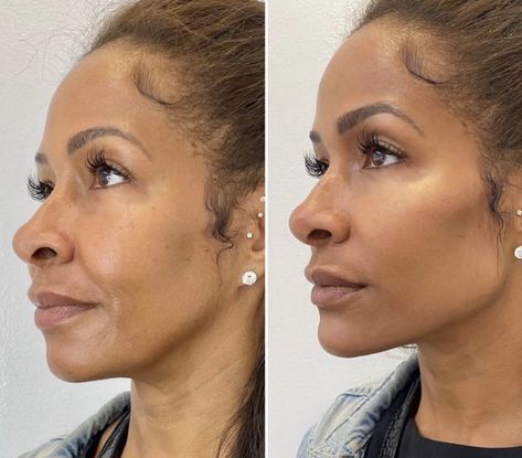 Jaw Filler, Jaw Reduction Surgery, Facial Balancing, Laser Face, Plastic Surgery Fails, Chin Filler, Facial Procedure, Skin Anatomy, Botox Before And After