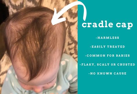 Cradle Cap: What it is? Where does it occur? How do you treat it?– T is for Tame Toddler Dry Scalp, Baby Dry Scalp, Flakey Scalp, 2 Month Baby, Doctor For Kids, Cradle Cap, Natural Exfoliant, Natural Shampoo, Mild Shampoo