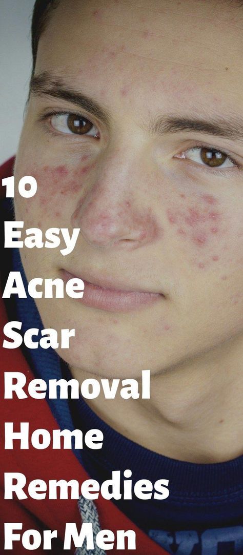 15 Instant Acne Scar Removal Tips For Men To Remember #RemediesToGetRidOfACold Clear Skin Men, Expensive Skin Care Products, Natural Remedies For Cold, Face Glowing, Chesty Cough, Teen Advice, Face Tips, Home Remedies For Acne, Skin Natural Remedies