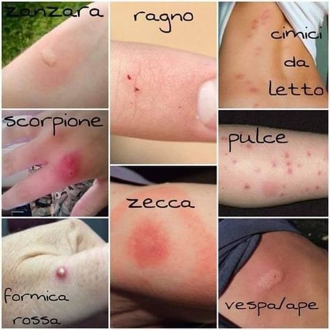 Bug Bites, Body Pain, Insect Bites, Glow Up?, Paw Print Tattoo, Healthy Life, Health Tips, Life Hacks, Health And Beauty