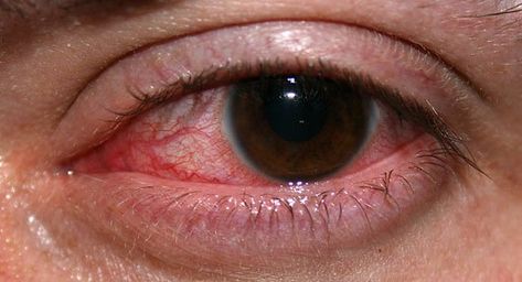 Bloodshot Eye, Dry Eye Symptoms, Bloodshot Eyes, Swollen Eyes, Fatigue Symptoms, Dry Cracked Lips, Chronic Fatigue Symptoms, Eye Pain, Irritated Eye