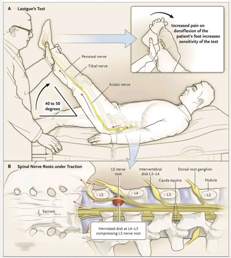 Physical Therapy School, Physical Therapy Student, Leg Raise, Straight Leg Raise, Remedial Massage, Physical Therapy Assistant, Basic Anatomy And Physiology, Massage Therapy Techniques, Lower Back Pain Exercises