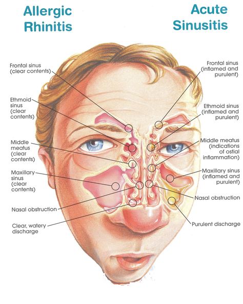 Sinus Medicine, Acute Sinusitis, Maxillary Sinus, Sinus Congestion Relief, Congestion Relief, Allergic Rhinitis, Sinus Congestion, Medical Anatomy, Sinus Infection