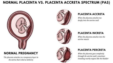 Placenta Abruption, Placenta Accreta, Study Sheets, Ultrasound Sonography, Nursing Study Guide, Pregnancy Progression, Nurse Midwife, Pregnancy Problems, Medical Student Study