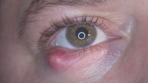 How To Get Rid Of Stye Eye Overnight, How To Get Rid Of A Stye In Your Eye, Stye Remedies Fast, Get Rid Of Stye, Stye Remedy, Eye Stye Remedies, Coping Methods, Newborn Feeding, Upper Eyelid