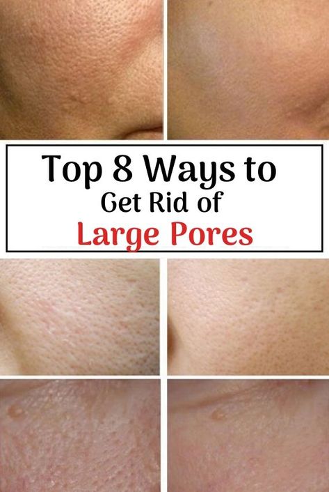 Face Care Routine Large Pores, How To Fix Large Pores, Best Skincare Products For Large Pores, Skincare Routine For Large Pores, Large Pores On Nose, Skincare For Enlarged Pores, Open Pores On Face, Pores On Face, Get Rid Of Pores