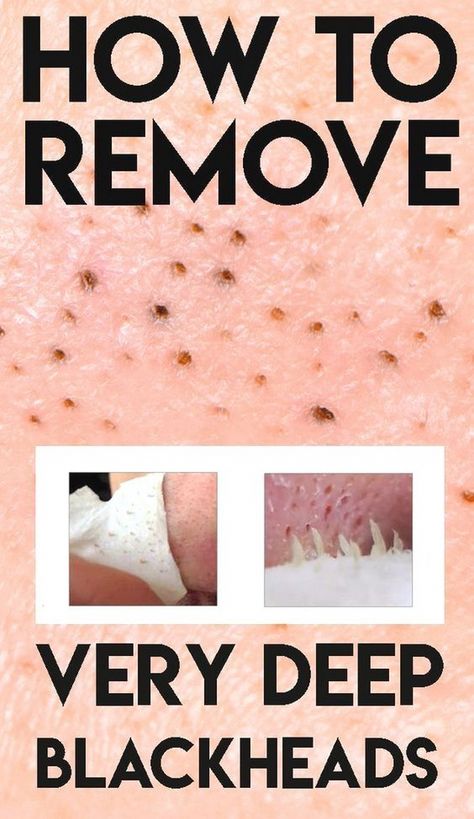 How To Remove Blackheads, Beauty Hacks That Actually Work, Black Head Remover Mask, To Remove Blackheads, Blackheads On Nose, Cold Sores Remedies, Remove Blackheads, Healthy Advice, Diy Remedies