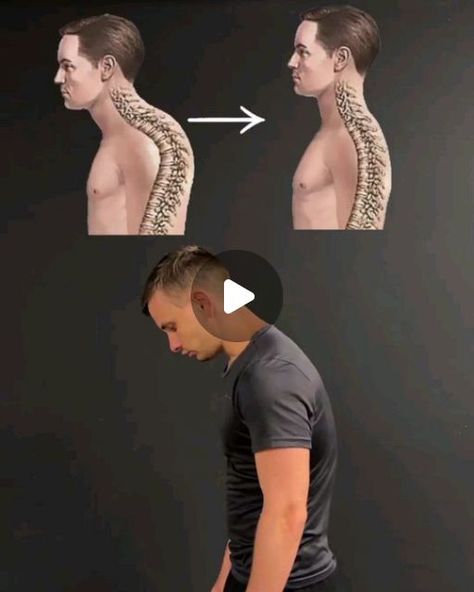 Learn Calisthenics on Instagram: "Get rid of the neck hump & upper back issues! MUST READ & SAVE ⚠️ By @makarin Neck hump is a visible bump at the back of your neck that can be caused by many different factors Most commonly, it's a posture issue caused by prolonged sitting and staring at your phone/desk, and lack of movement in your upper back Why should you prevent or try to fix the neck hump? ⚠️⚠️ May lead to protrusions and hernias of the cervical region ⚠️ May cause numbness of hands Back Hump How To Get Rid Of, How To Get Rid Of Hump On Back Of Neck, Neck Bump How To Get Rid Of, Neck Hump Get Rid Of, Fix Neck Hump, Learn Calisthenics, Back Hump, Dowager's Hump, Upper Back Exercises